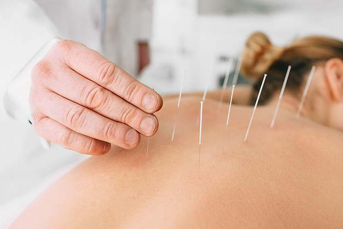 acupuncture anxiety stress